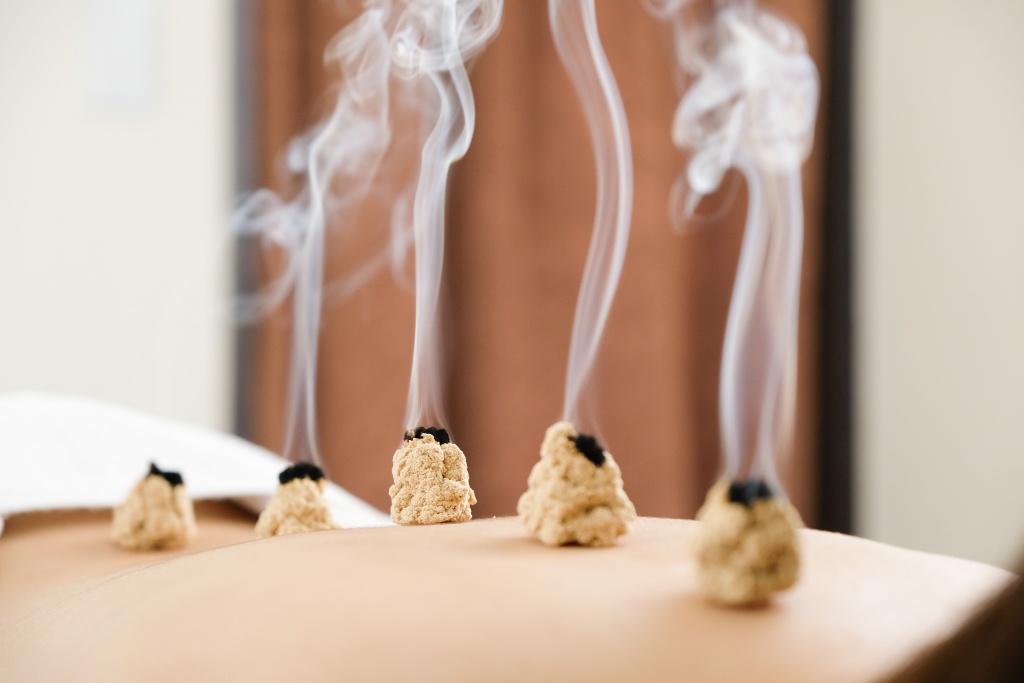 acupuncture-and-moxibustion-on-the-back-of-a-woman-2023-11-27-04-59-36-utc.jpg